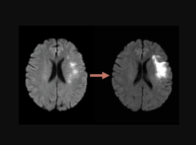 Right Side Brain Stroke